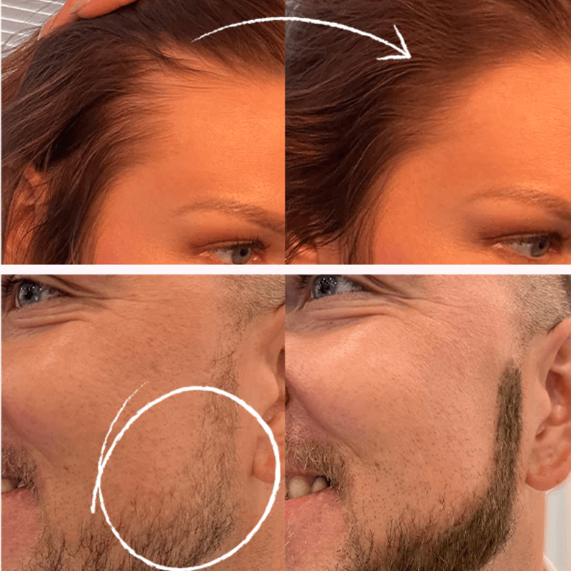 Η πούδρα Hairline καλύπτει άμεσα την τριχόπτωση, την αναγέννηση και την τροποποίηση της τρίχας.